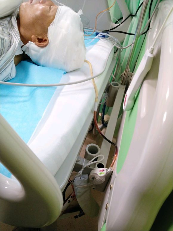 做完手术初步鉴定高级别胶质瘤