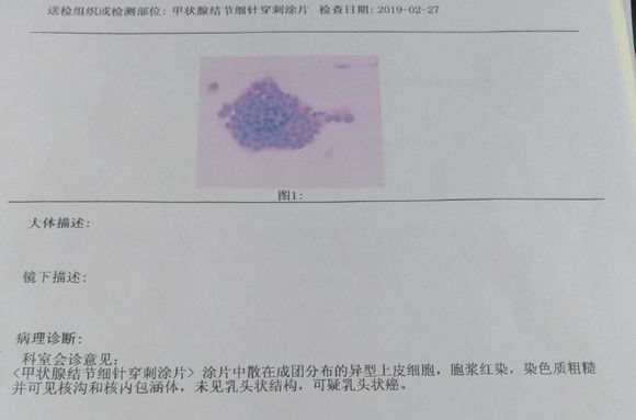 29岁检查出了甲状腺癌，感觉人生灰暗了
