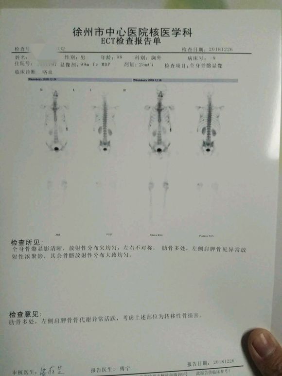 求助小细胞肺癌治疗方法